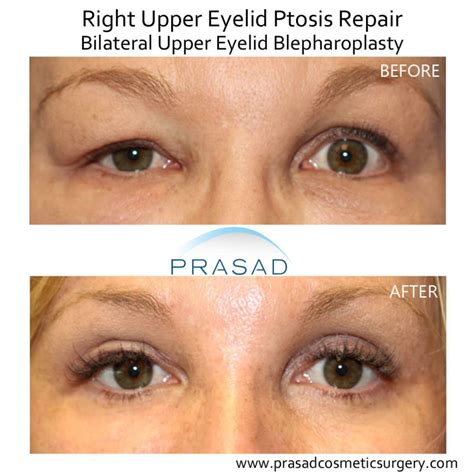 Droopy Eyelid Surgery: Eyelid Ptosis Procedure, and Recovery