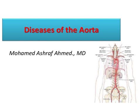 Diseases of the aorta