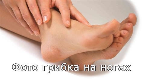 Как выглядит грибок на теле человека фото
