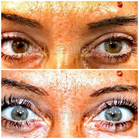 eye color change surgery laser eye color change surgery