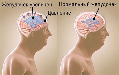 Гидроцефалия - симптомы, признаки, диагностика, лечение