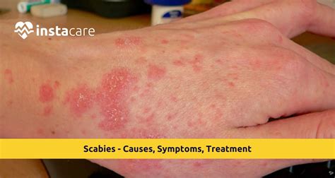 Scabies: Symptoms, Causes, Treatment Options, Remedies & Prevention Tips