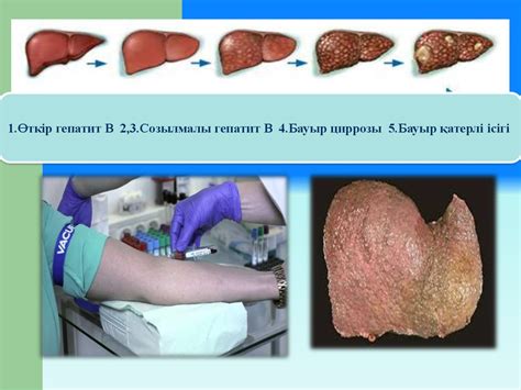 Вирусты гепаттиттер А,В,С,Д,Е және т.б. этиологиясы, эпидемиологиясы ...