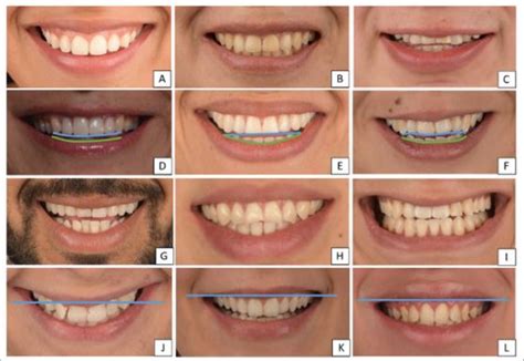Classification of smile line, smile arc, smile types, and upper lip ...