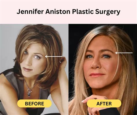 Before & After: Analyzing Jen Psaki's Possible Plastic Surgery - wn83klc
