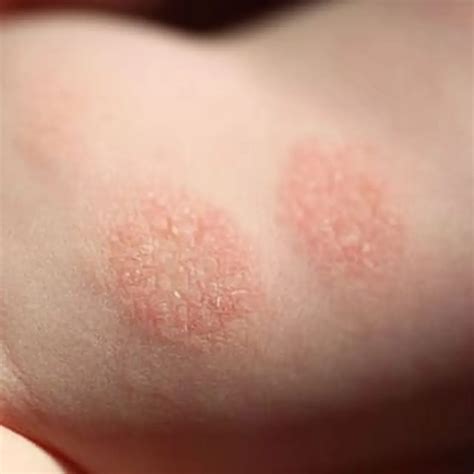 nummular dermatitis dermatologists located  fairfax va