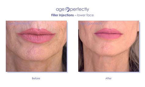 filler lower face1 | Age Perfectly