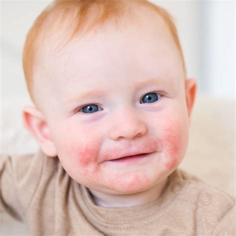 Atopische Dermatitis – Ursache & Behandlungsmethoden