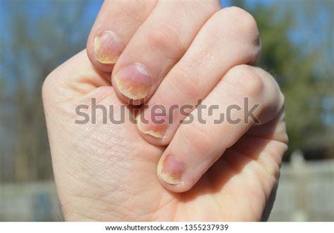 Nail Psoriasis All Fingernails On Left Stock Photo (Edit Now) 1355237939