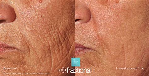 Best Laser for wrinkles, best laser for anti-ageing, sun spots ...