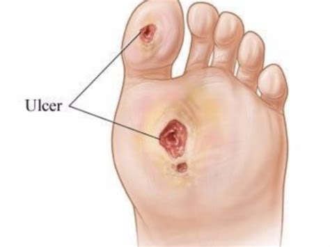 Diabetic Foot Ulcers - Texas Orthopedic and Spine Associates