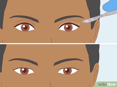 Upper Eyelid Exposure Explained + How to Get Rid of It