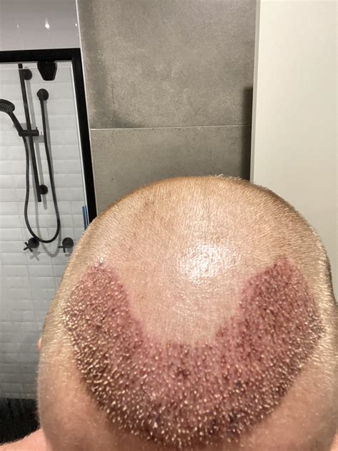 Does this look like 2000 grafts? : r/HairTransplants