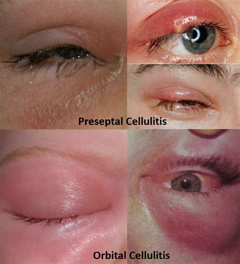 Swollen Eyelid Know The Causes Remedies And Alert Signs