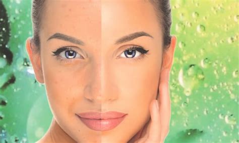 BioRePeel – Erneuere deine Haut bei Final Shape