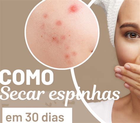 O Que Usar Para Secar Espinha - Como secar espinha menos de 30 dias