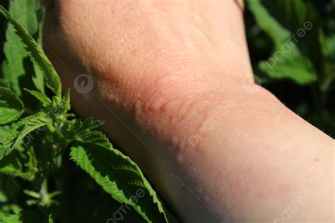 50 Stinging Nettle Rash Photos, Pictures And Background Images For Free