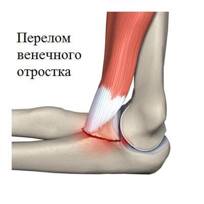 Перелом венечного отростка локтевой кости: последствия, осложнения, лечение