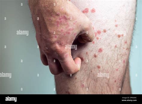 Unrecognizable man suffering from psoriasis, scratching thick scaly ...