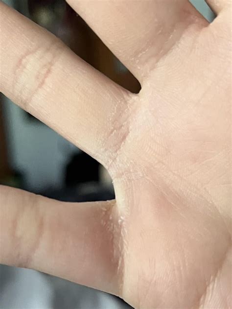Is this just dry skin or some sort of fungal infection? : r/SkincareAddicts