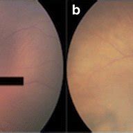 Fundus pigmentation grading system: a blonde fundus b medium fundus and ...