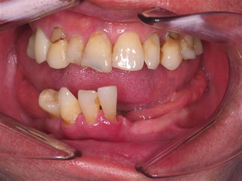 Restoring a severely worn teeth... - Uptown Dental Surgery