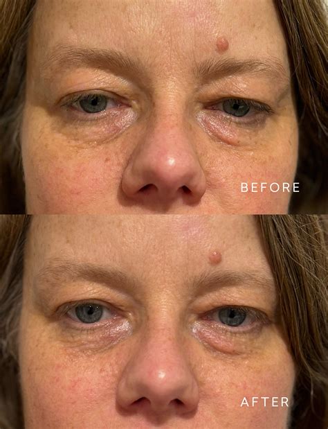 natural facelift