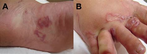 Hookworm infection, symptoms, diagnosis & hookworm treatment in humans