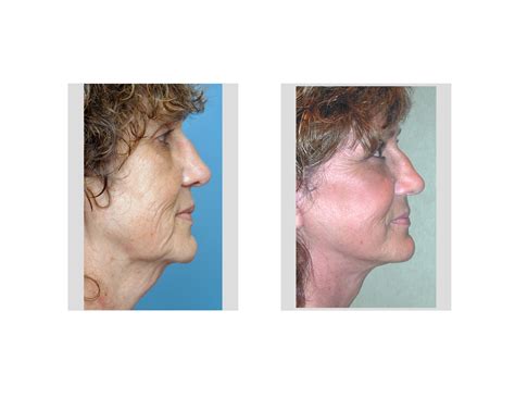 facelift rejuvenation indianapolis dr barry eppley explore plastic