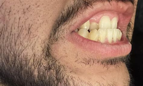 braces fix  asymmetrical face raskdentists