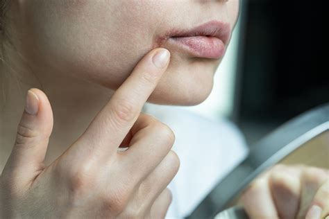 How to Prevent and Treat Angular Cheilitis | Banner Health