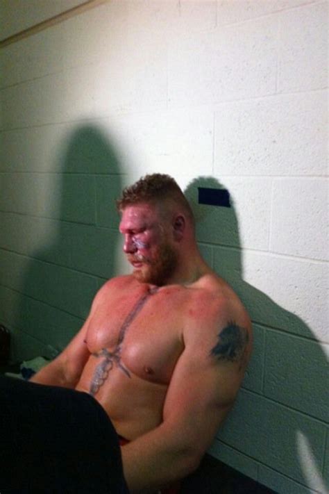 The Picture of Pain: Brock Lesnar After UFC 121