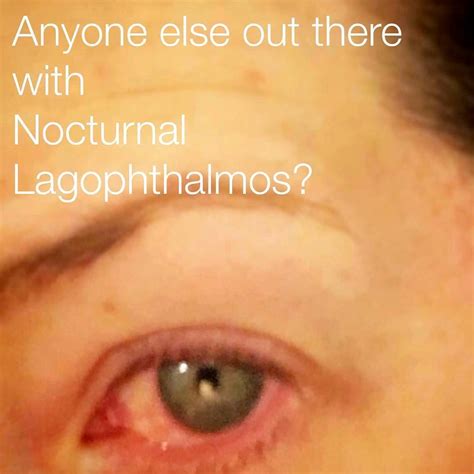 Nocturnal Lagophthalmos » Eyelid Surgery: Cost, Photos, Rewiews, Q&A