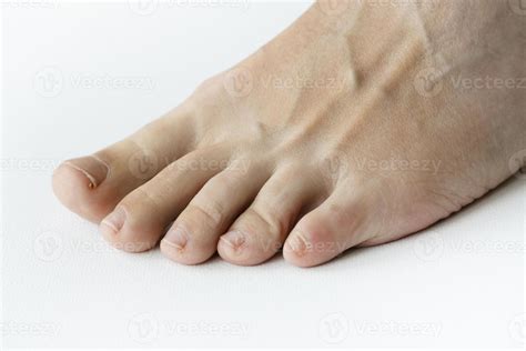 Foot treatment without pedicure in SPA, unkempt, the patient's foot