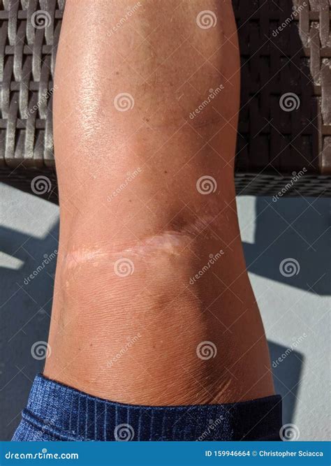 Scar In My Knee at Darrell Tackitt blog