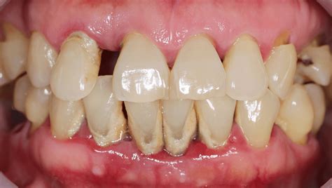 What is Dental Plaque? | Atlas Dental, Toronto Dentist