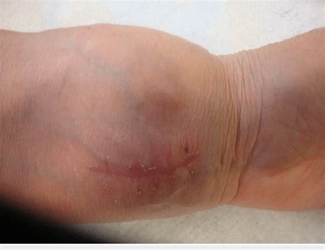 scar   incision due   prior biopsy   palpable mass