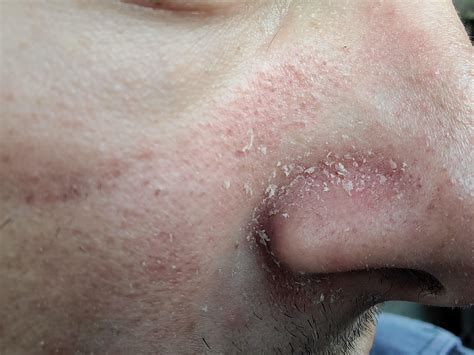 I need help figuring out why my face gets like this, red and flaky