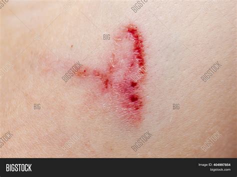 Deep Skin Cut