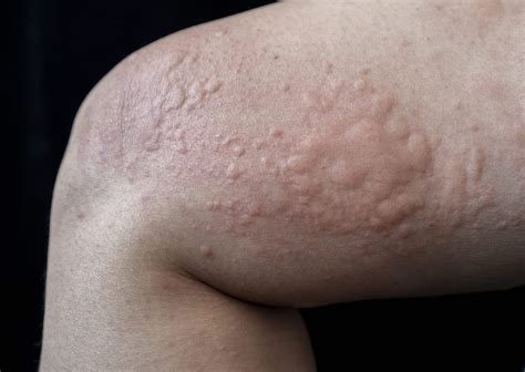 50 Facts About Urticaria - Facts.net