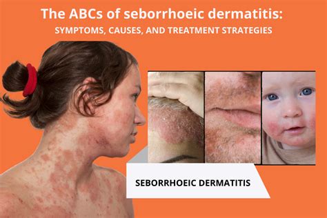 seborrheic dermatitis chest rash