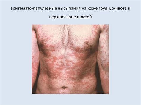 Методы диагностики инфекционных заболеваний. Медсестринская диагностика ...