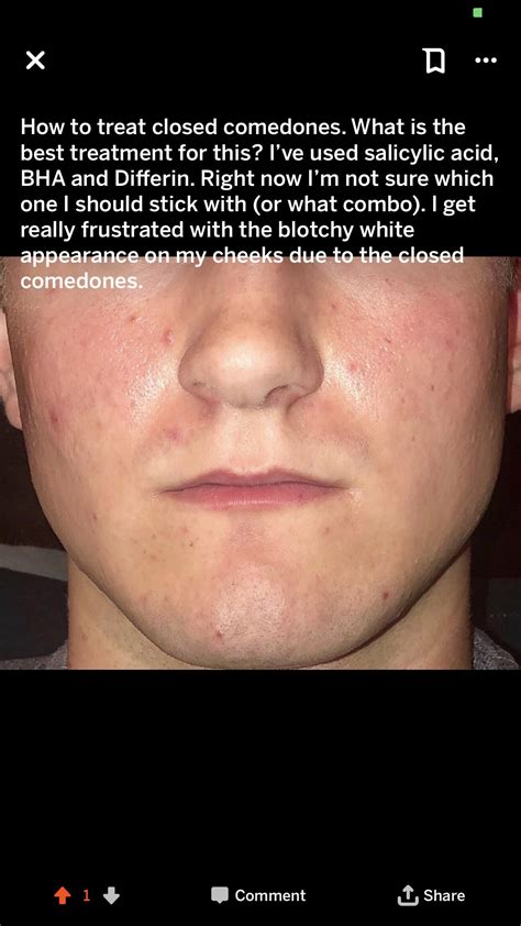 Closed comedones : r/acne