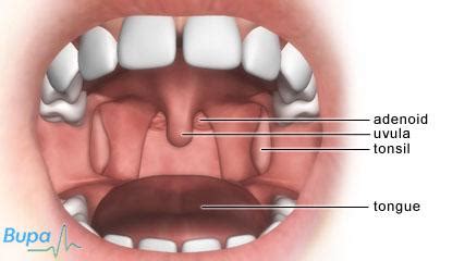 Recovery Time For Tonsil Removal / What Causes Tonsil Stones Symptoms ...