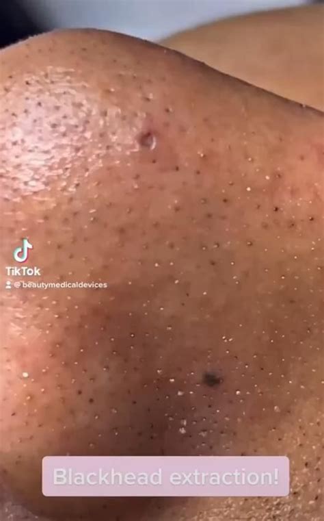 This Blackhead Removal Trick Blew My Mind (2024 Update!) - pxmtxdz