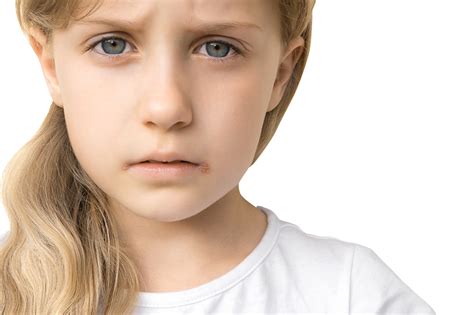 Perché viene l'Herpes nei bambini? - PianetaMamma.it