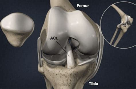 Anterior Cruciate Ligament - ACL Tear - Symptoms, Prevention & More