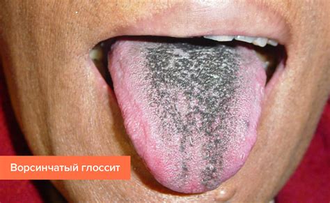 Лечение глоссита – препараты и народные средства