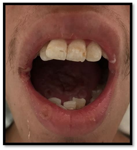 Angular Cheilitis Hiv