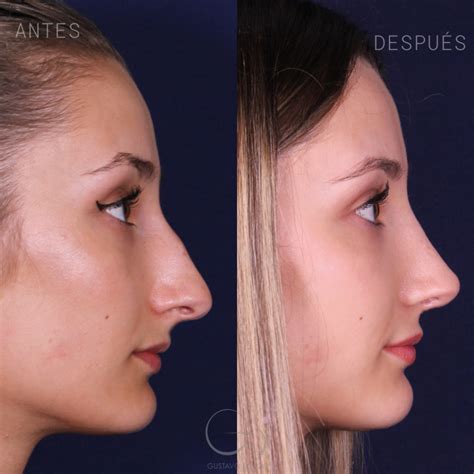 Qual O Valor De Uma Rinoplastia - 【Rinoplastia: O que é, Tipos e Preços: Guia Completo 2026】